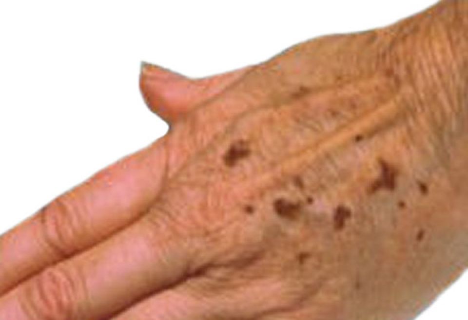 Age Spots Home Remedy
