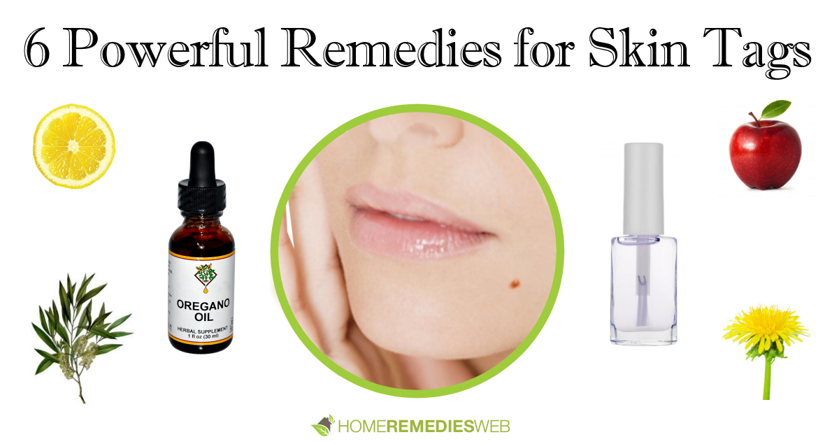 6 Powerful Remedies for Removing Skin Tags