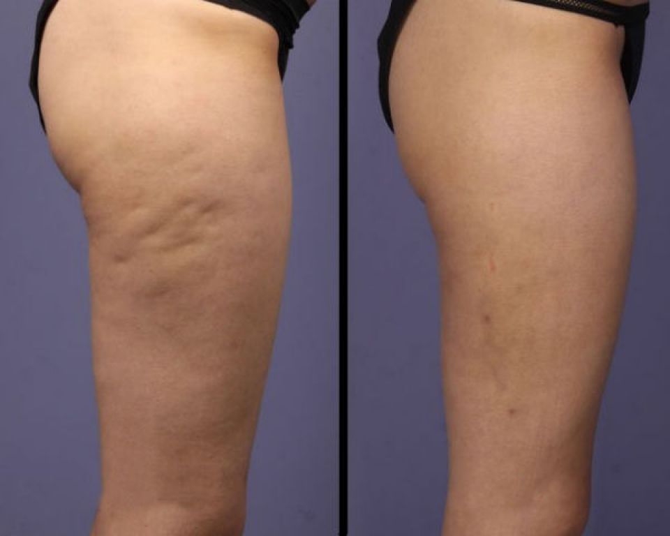 fluid how reduce retention Remedy Home Cellulite