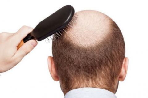 Hair Loss and Balding